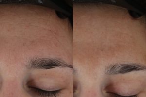 006 Baseline vs 3 months after 2 halo txs for skin texture and pore size - close up forehead
