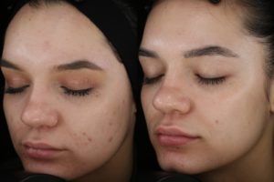 008 Baseline vs 5 months after 1 Halo and BBL tx for skin texture-acne scarring-pore size-and redness - Left