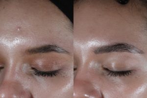 009 Baseline vs 5 months after 1 Halo and BBL tx for skin texture-acne scarring-pore size-and redness - close up
