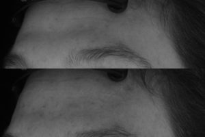 012 Baseline vs immediately after restylane silk to feminize and recreate a youthful forehead contour