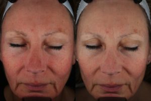 013 Baseline vs after 1 laser genesis tx for facial redness