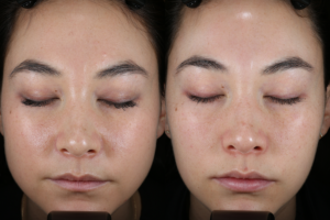 018 baseline vs 2 months after botox to masseter for jawline contouring and restylane silk to lips