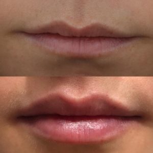019 baseline vs immediately after restylane silk to lips