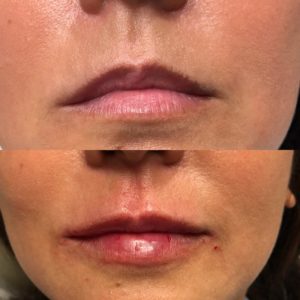020 baseline vs immediately after restylane silk to lips