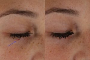 023 baseline vs after 1 month after 1 excel v tx for spider angioma under the eyelid