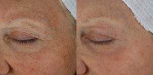 028 baseline vs after 1 Profractional laser treatment to upper and lower eyelids