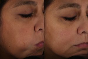 029 baseline vs after 1 excel v tx for telangiectasias on the cheek