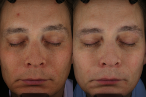 012 Baseline vs after months after 1 FYBBL tx for photoaging -for redness and brown spots - front