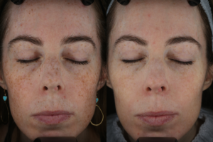 Baseline vs 1 month after 1 FYBBL