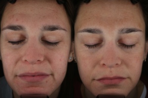 002 Baseline vs 3 months after 2 halo txs for skin texture and pore size - Front