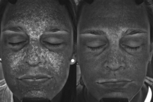 003 Baseline vs 3 months after 2 halo txs for skin texture and pore size - front highlighted decreased appearance of pores