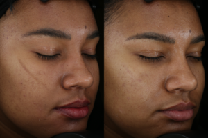 005 Baseline vs 1 month after 1 picotoning tx for hyperpigmented scar
