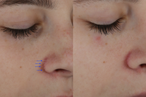 009 Baseline vs 1 week after 3 excel v tx and one single spot erbium to correct rhinoplasty scars around the nose