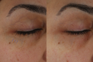 013 baseline vs after 2 excel v txs periorbital blue veins
