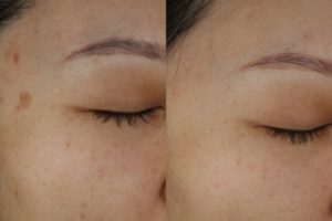 019 baseline vs 1 month after picosecond laser for brown spots