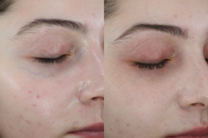 023 baseline vs after 2 excel v txs periorbital blue veins